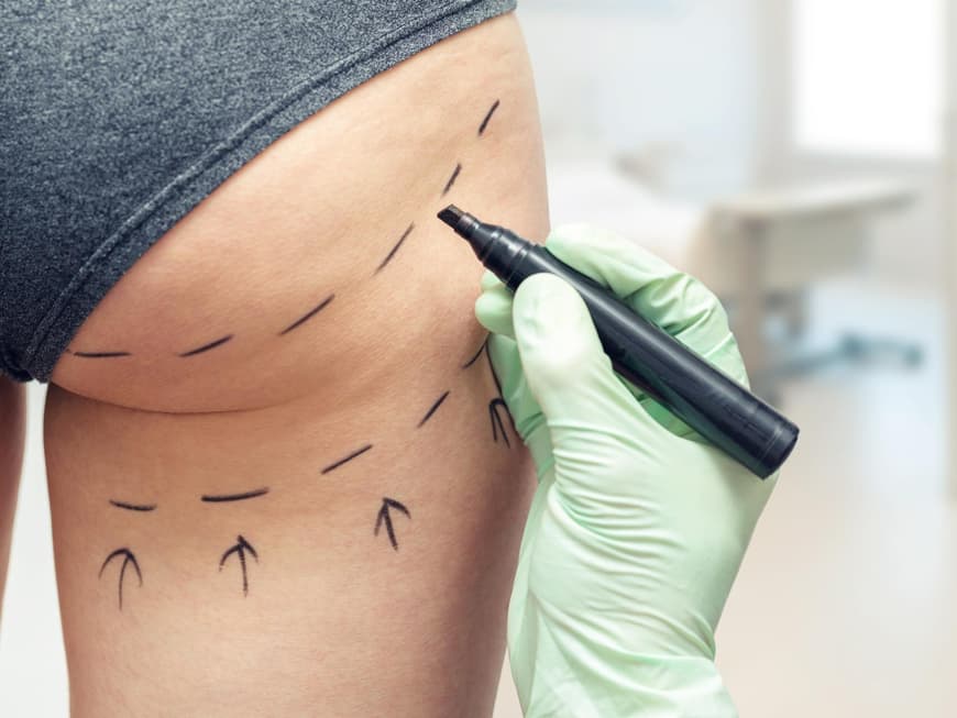 Fettabsaugung Markierung zur Fettabsaugung am Po